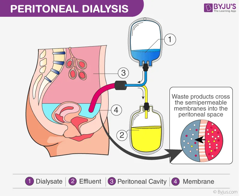 Peritoneal dialysis